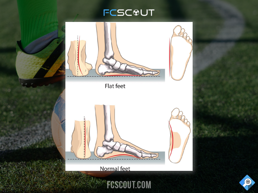 Soccer flat feet vs normal feet